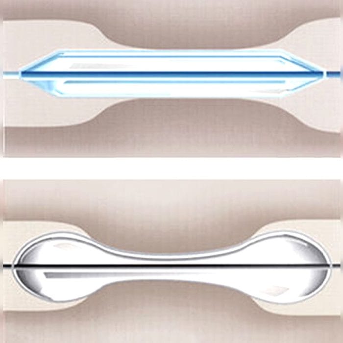 Dilatation Catheter 2