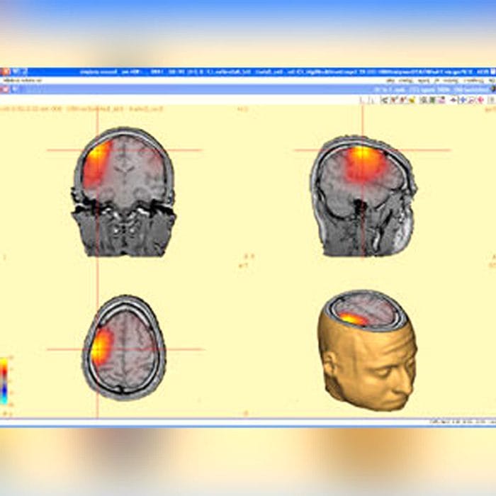 Eeg Amplifier 1