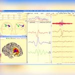 Eeg Amplifier 5