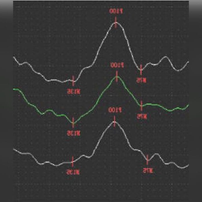 Electroretinograph 2