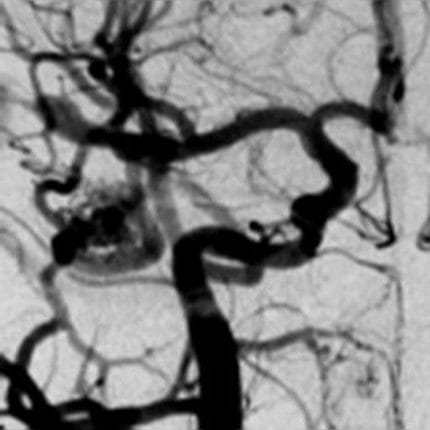 Embolization Coil 1