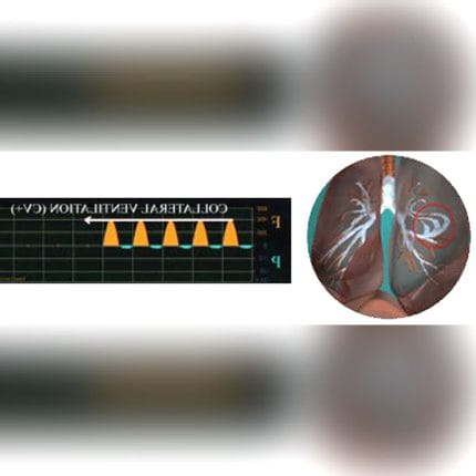 Emphysema Detection Respiratory Monitor 1