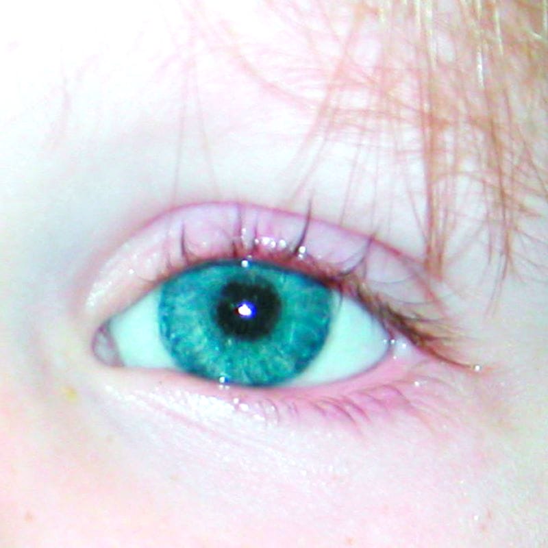 Eye-Cosmetic-Prosthesis-49e3d37f263828582c629e4de4b95fd2 Eye Cosmetic Prosthesis