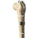 Femoral Compression Plate