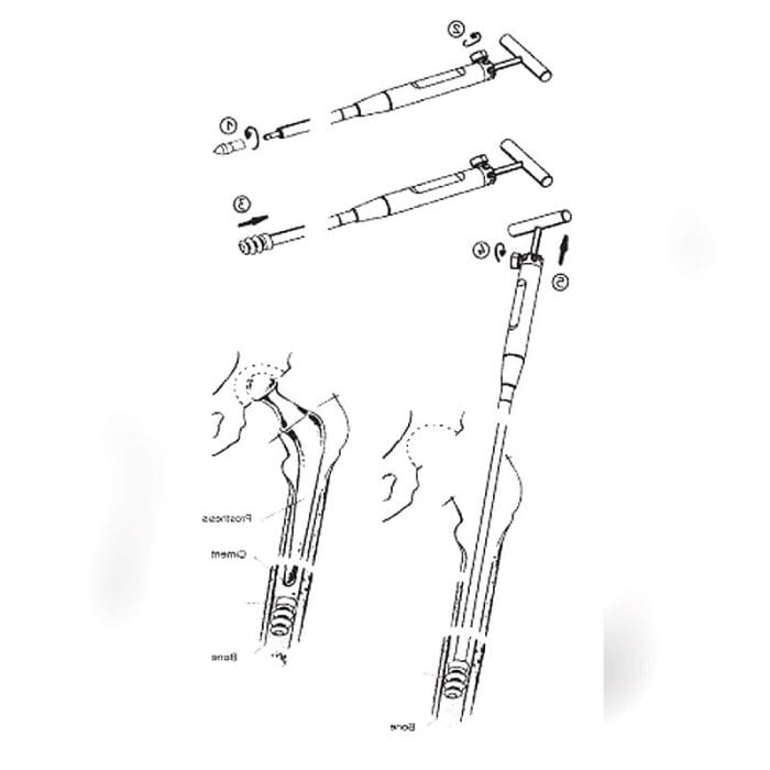 Femoral Diaphyseal Restrictor 1