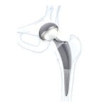 Femoral Head Prosthesis 1