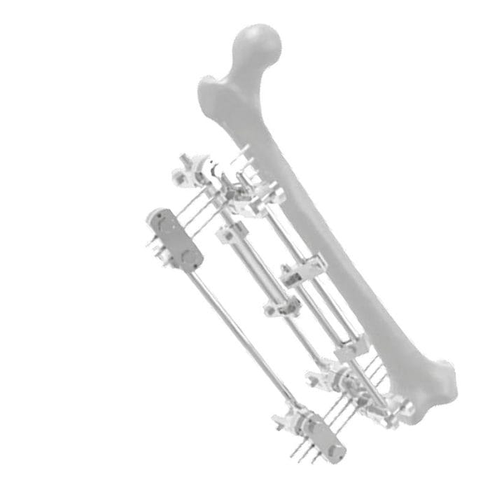 Femur External Fixation System