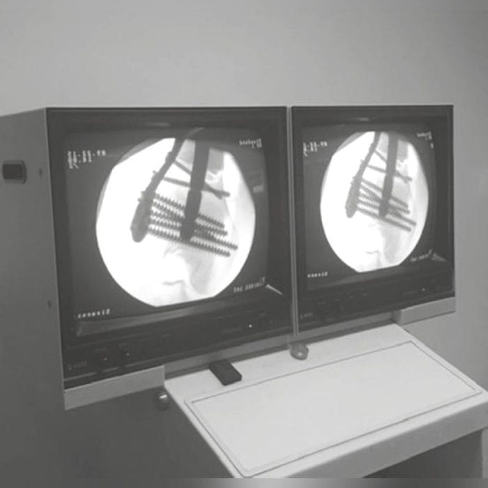 Femur Osteotomy Plate 1