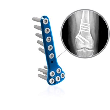 Femur Osteotomy Plate 1