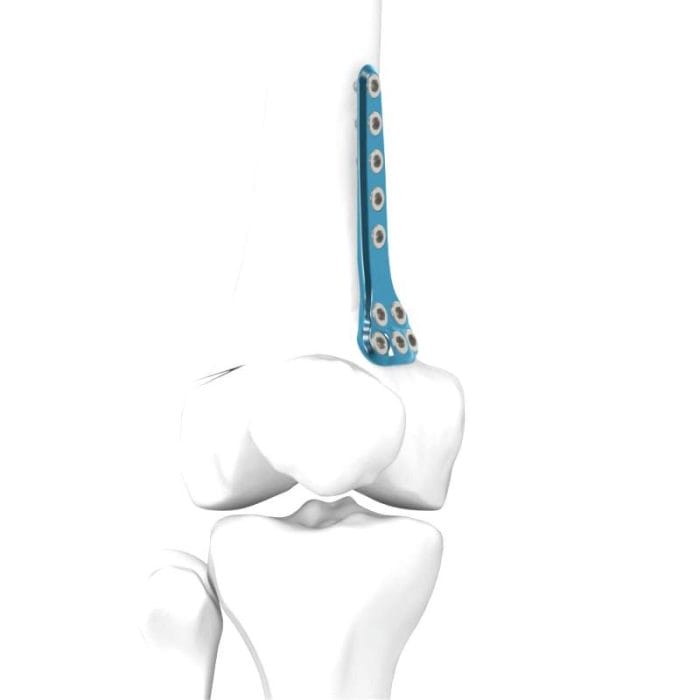 Femur Osteotomy Plate 4