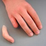 Finger Cosmetic Prosthesis