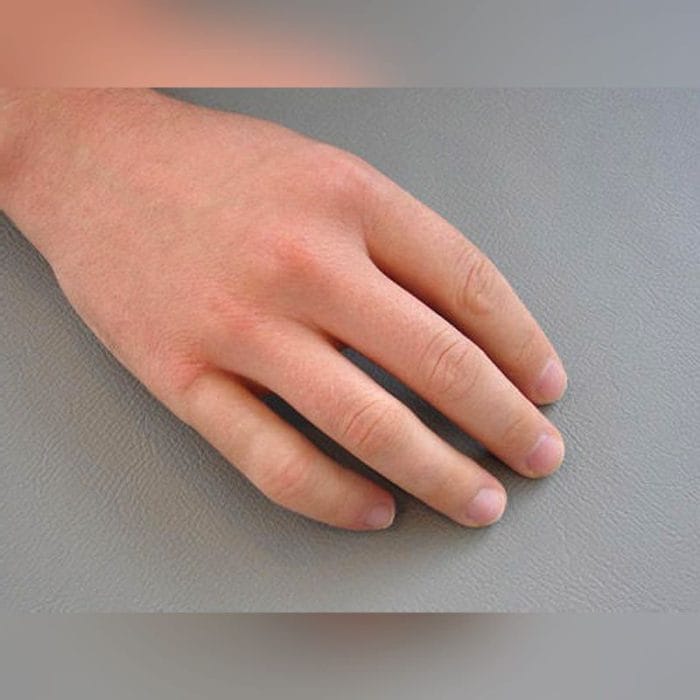 Finger Cosmetic Prosthesis 2