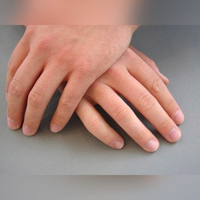 Finger Cosmetic Prosthesis 3