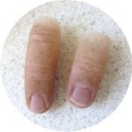 Finger Cosmetic Prosthesis