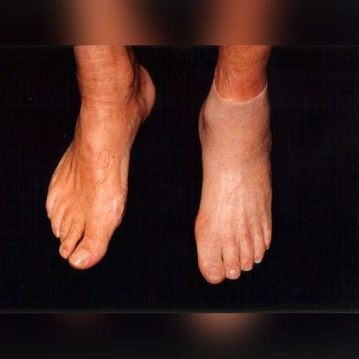 Foot Cosmetic Prosthesis 2