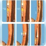 Gastroesophageal Ph Meter 4