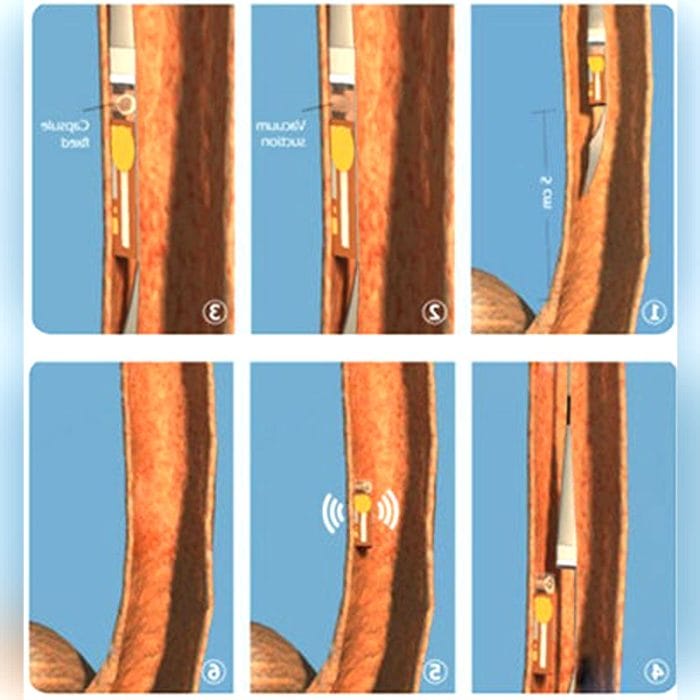 Gastroesophageal Ph Meter 4