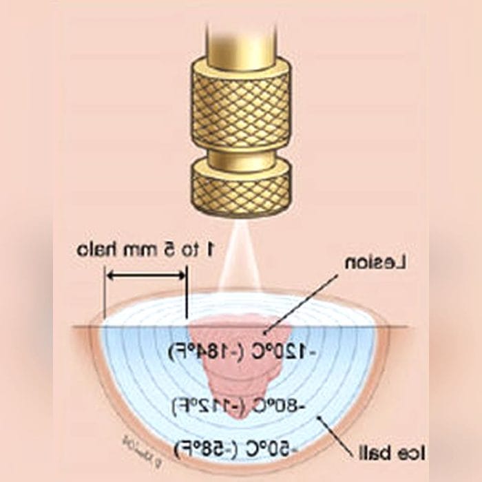 Gynecological Surgery Cryosurgery Unit 2