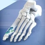 Hallux Valgus Arthrodesis Plate