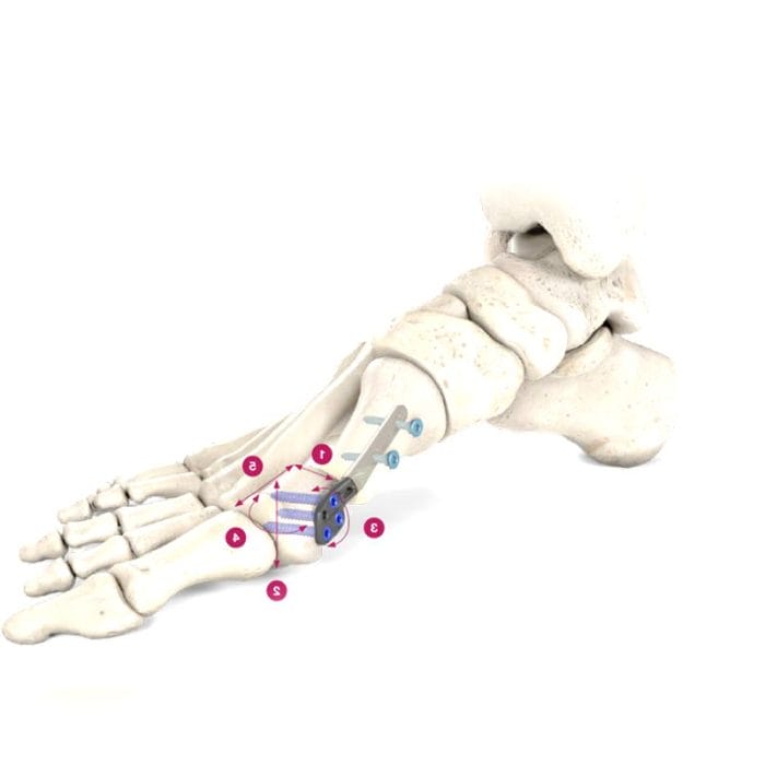 Hallux Valgus Osteotomy Plate 2