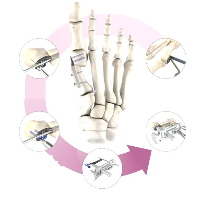 Hallux Valgus Osteotomy Plate 3