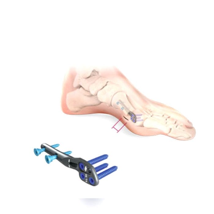 Hallux Valgus Osteotomy Plate