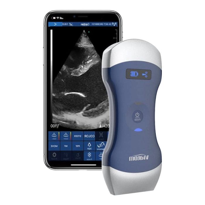 Hand-Held Ultrasound System 1