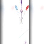 Hemodialysis Catheter 3