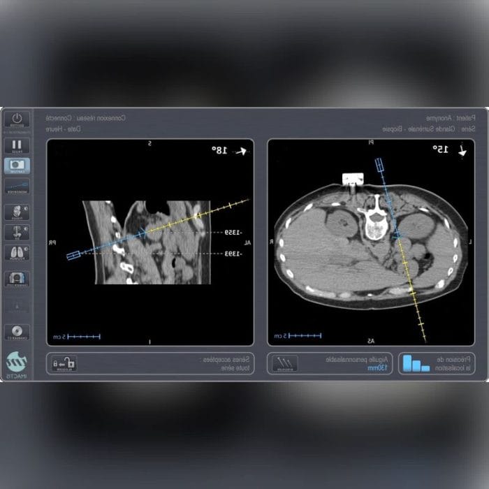 Hepatic Biopsy System 5