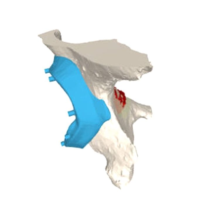 Hip Prosthesis Resection Guide 1