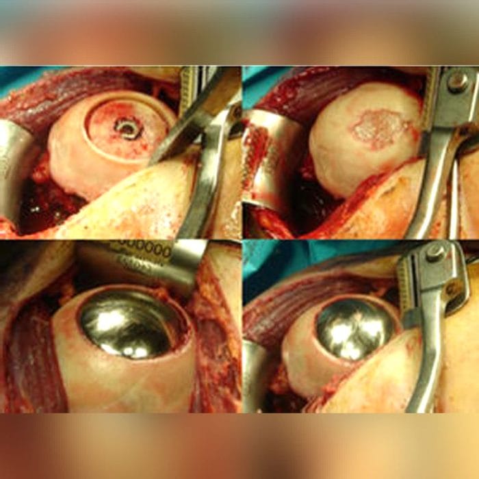 Humeral Head Prosthesis 3