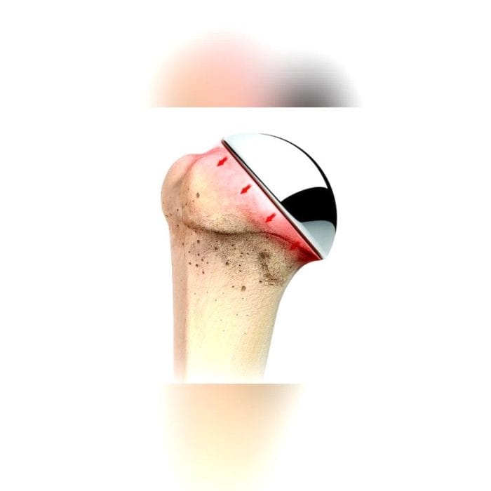 Humeral Head Prosthesis 5