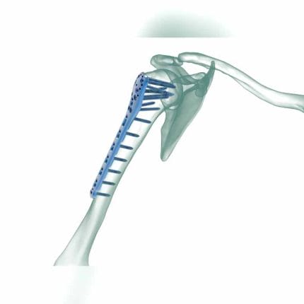 Humerus Compression Plate 1