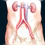 Iliac Artery Vascular Bioprosthesis 1