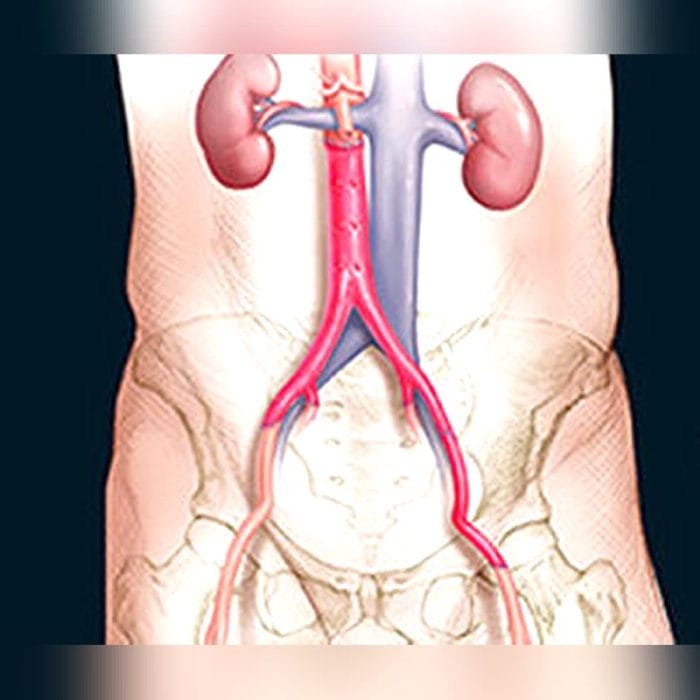 Iliac Artery Vascular Bioprosthesis 2