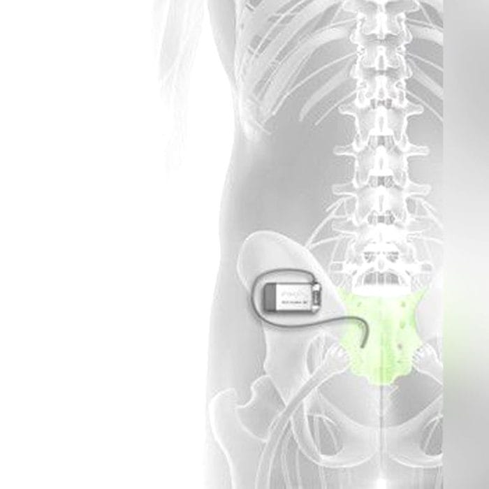 Implantable Neurostimulator 2