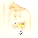 Implantable Venous Port 1