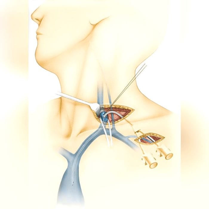 Implantable Venous Port 2