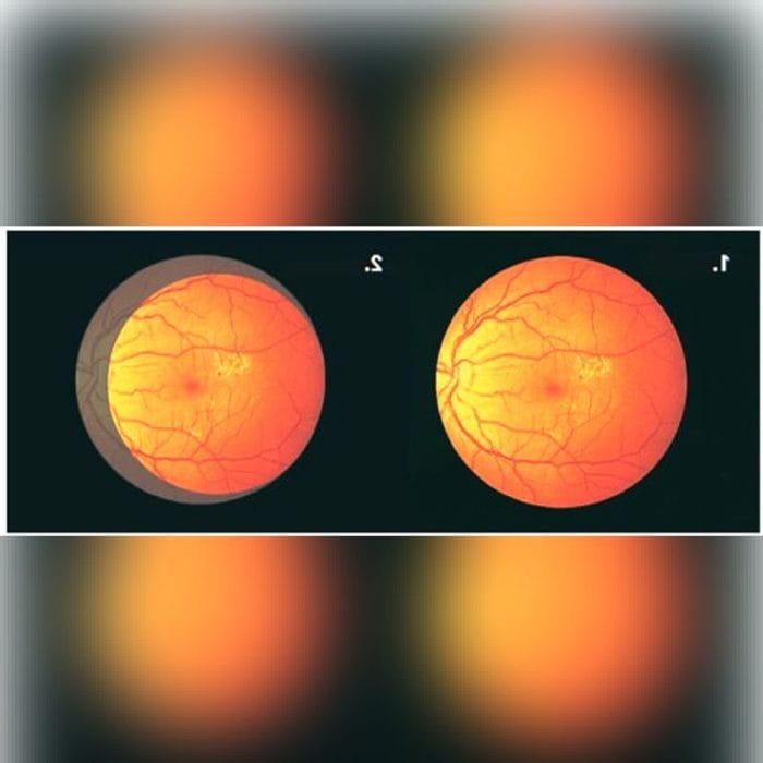 Indirect Ophthalmoscope 7