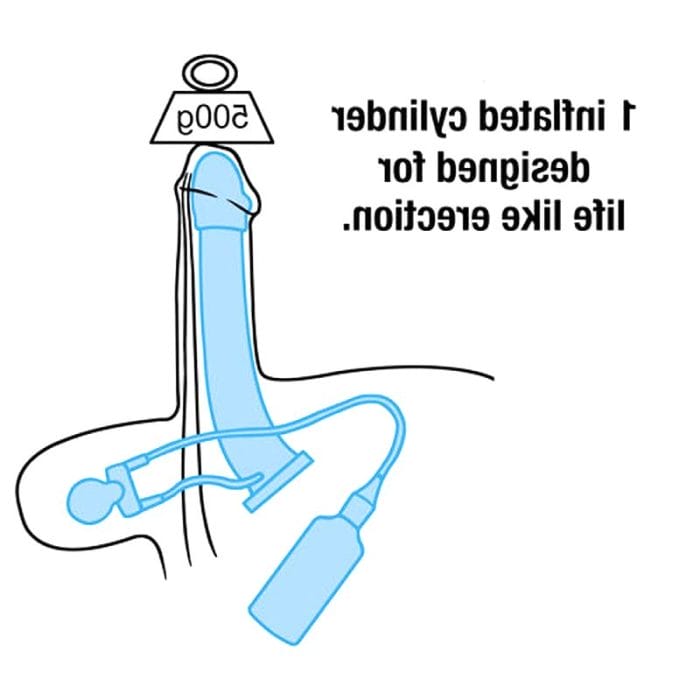 Inflatable Penile Prosthesis 4