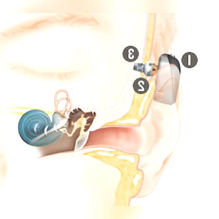 Internal Component Bone Conduction Implant 3