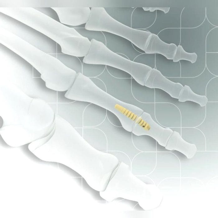 Interphalangeal Foot Joint Arthrodesis Screw 1