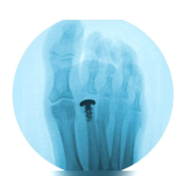 Interphalangeal Foot Joint Implant 1