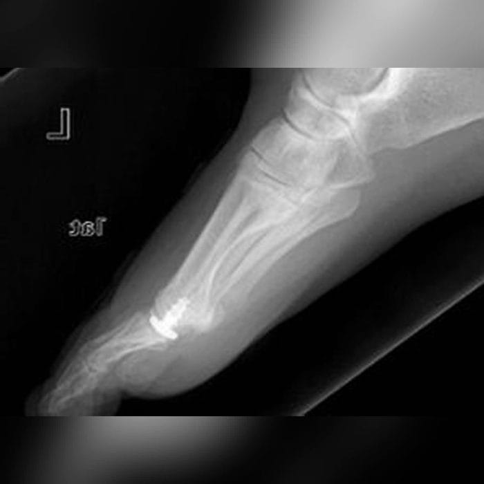 Interphalangeal Foot Joint Implant 2