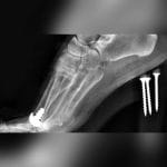 Interphalangeal Foot Joint Implant 5