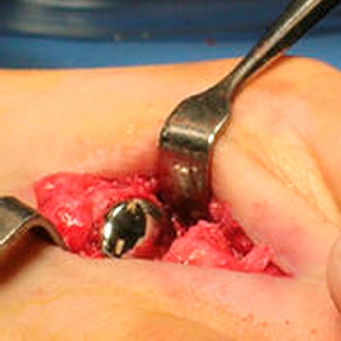 Interphalangeal Foot Joint Implant