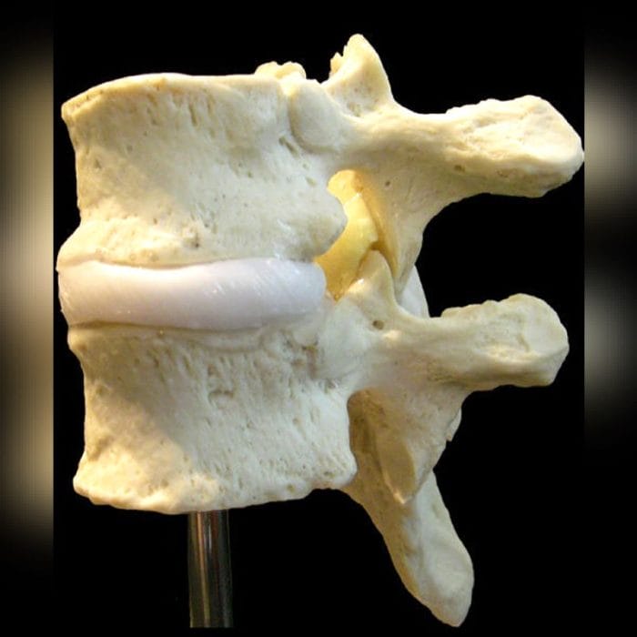 Intervetebral Disc Model