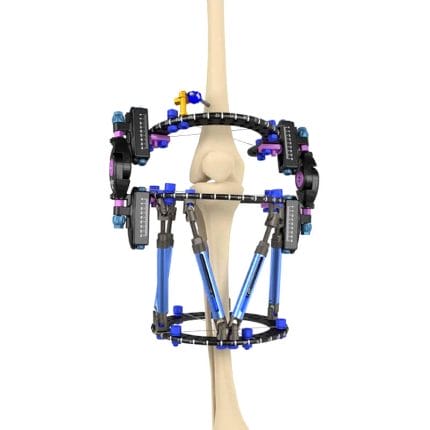 Knee External Fixation System