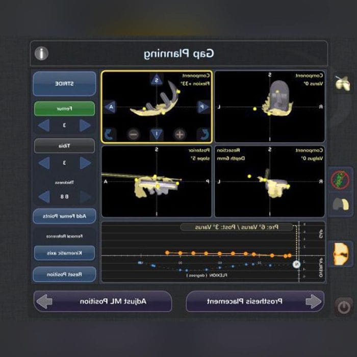 Knee Prosthesis Positioning Surgical Navigation System 2