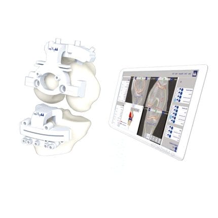 Knee Prosthesis Resection Guide